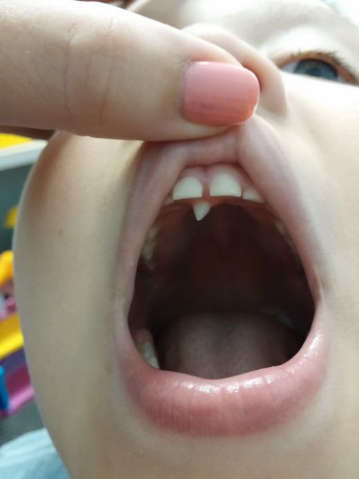 Как выдернуть молочный зуб ребенку в домашних условиях без последствий для здоровья